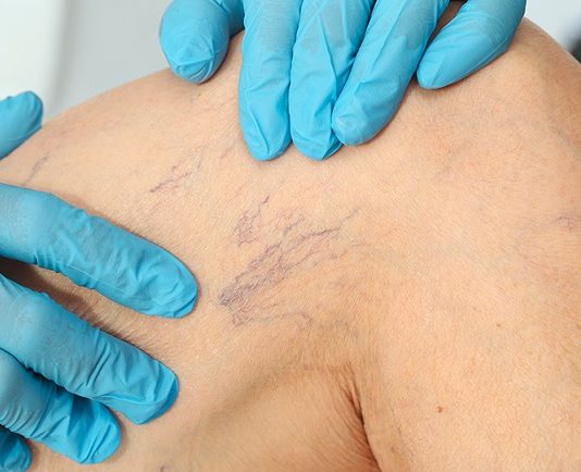 Как происходит удаление сосудистых звездочек