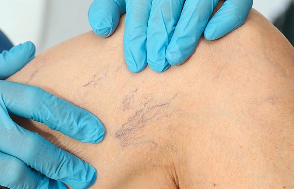 Как происходит удаление сосудистых звездочек