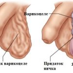 Варикоцеле у мальчиков