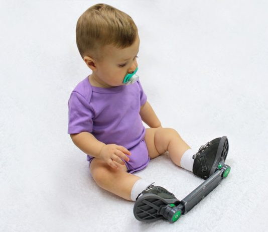 Как победить косолапость с помощью брейсов