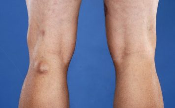 Каким образом можно вылечить кисту Бейкера