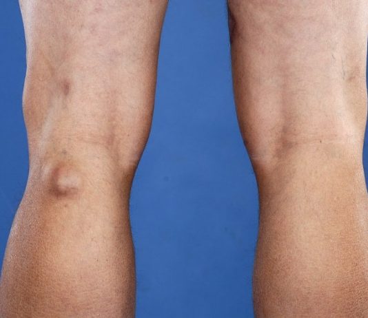 Каким образом можно вылечить кисту Бейкера