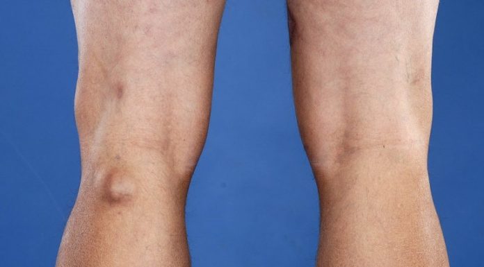 Каким образом можно вылечить кисту Бейкера