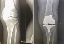 Где сделать эндопротезирование коленного сустава