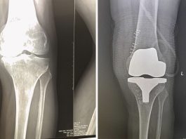 Где сделать эндопротезирование коленного сустава