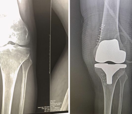 Где сделать эндопротезирование коленного сустава