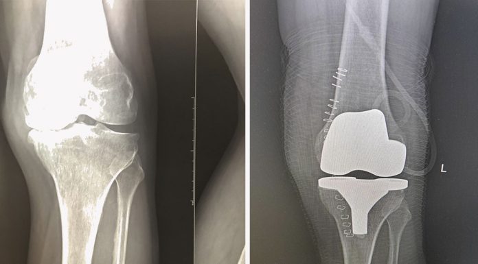 Где сделать эндопротезирование коленного сустава