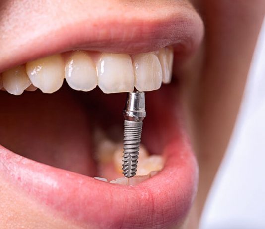 Топ 5 компаний по трансплантации зубов