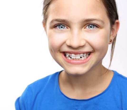 Исправление прикуса у детей: методы выравнивания