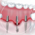 Имплантация зубов: все преимущества и недостатки