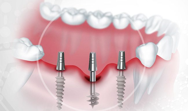 Имплантация зубов: все преимущества и недостатки