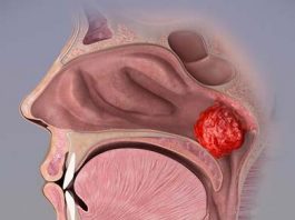 Как проходит операция по удалению аденоидов?