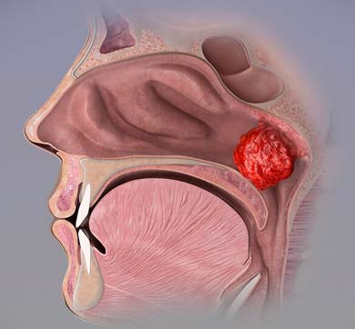 Как проходит операция по удалению аденоидов?