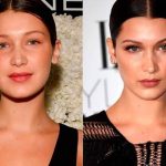 Как меняется лицо после удалении комков Биша?