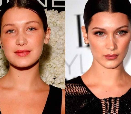 Как меняется лицо после удалении комков Биша?