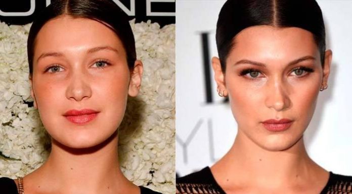 Как меняется лицо после удалении комков Биша?