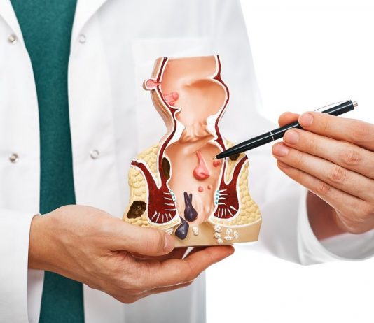 Какой самый эффективный метод лечения геморроя?