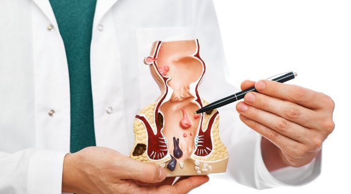 Какой самый эффективный метод лечения геморроя?