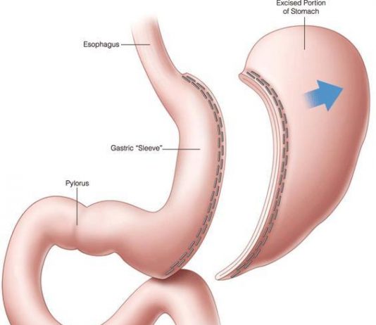 Лапароскопическая гастропластика: мой личный опыт операции по уменьшению желудка в центре bariatr.com.ua.