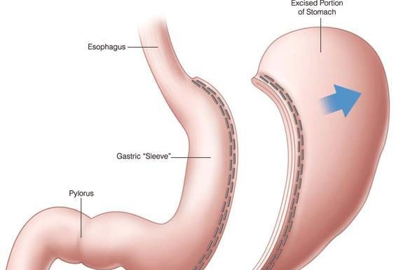 Лапароскопическая гастропластика: мой личный опыт операции по уменьшению желудка в центре bariatr.com.ua.
