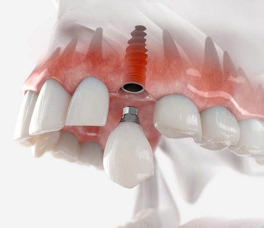 Имплантация зубов и что о ней нужно знать