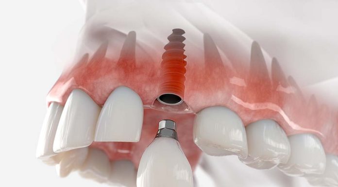 Имплантация зубов и что о ней нужно знать