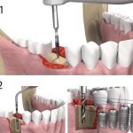 Как ставят зубные импланты: этапы и сроки имплантации