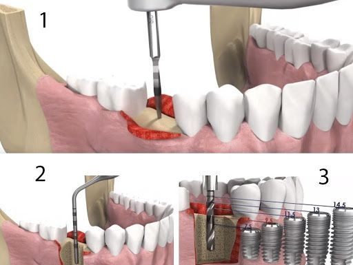 Как ставят зубные импланты: этапы и сроки имплантации