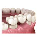 Какие сейчас ставят зубные протезы?