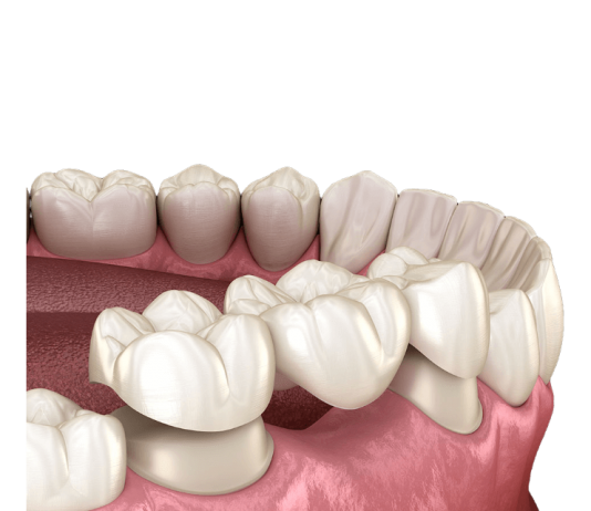 Какие сейчас ставят зубные протезы?