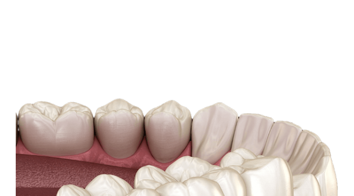 Какие сейчас ставят зубные протезы?