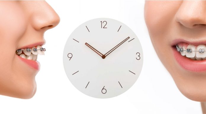 Факторы влияющие на продолжительность лечения брекетами