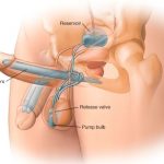 Как происходит протезирование полового члена