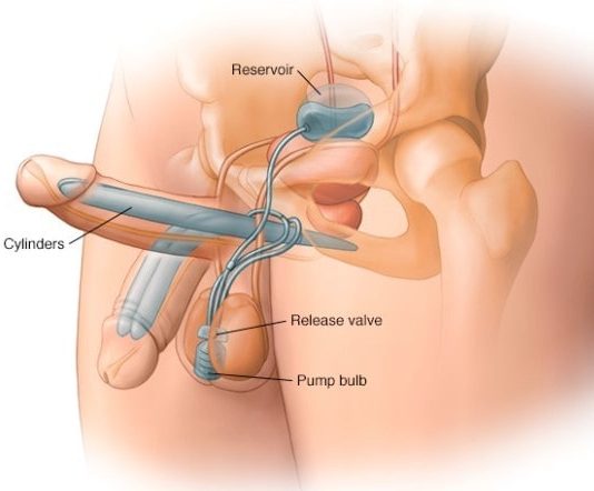 Как происходит протезирование полового члена