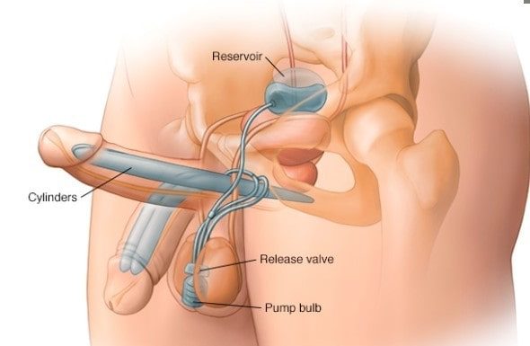 Как происходит протезирование полового члена