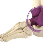 Что такое эндопротезирование голеностопного сустава