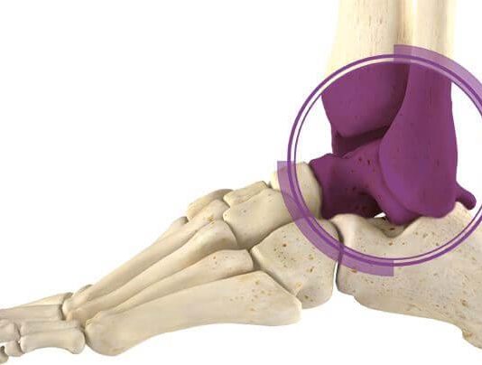 Что такое эндопротезирование голеностопного сустава