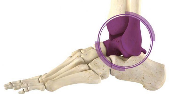 Что такое эндопротезирование голеностопного сустава