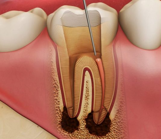 Как проводится лечение пульпита