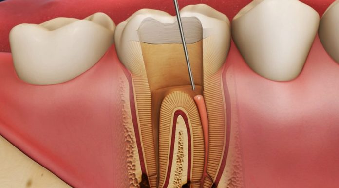 Как проводится лечение пульпита