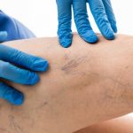 Варикоз: причины, признаки, методы лечения