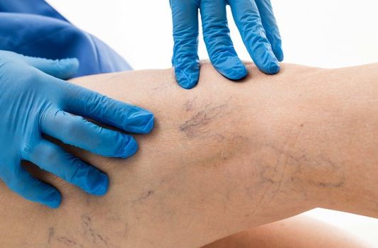 Варикоз: причины, признаки, методы лечения