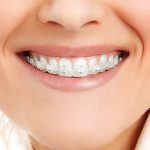 Что подразумевает ортодонтическое лечение