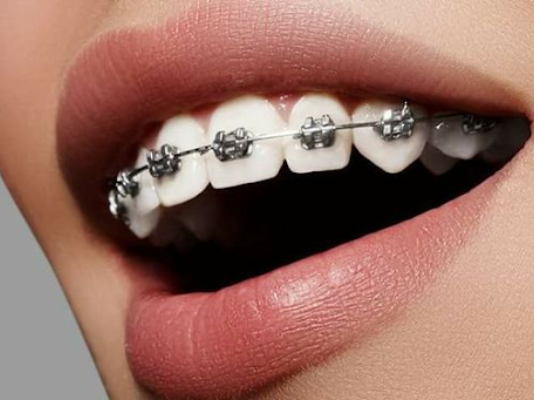 От чего зависит стоимость лечения брекетами