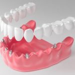 Что такое имплантация на 6 имплантах