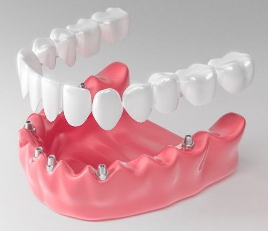 Что такое имплантация на 6 имплантах