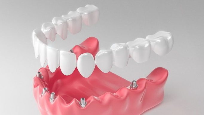 Что такое имплантация на 6 имплантах