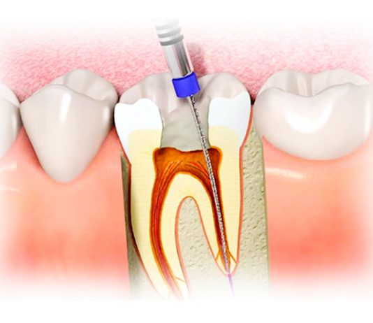 Как сейчас лечат пульпит