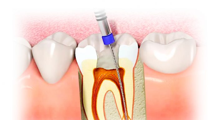Как сейчас лечат пульпит