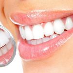 Современные методики отбеливания зубов